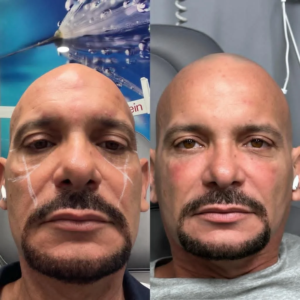 Pómulos más proyectados y un rostro con mayor estructura.