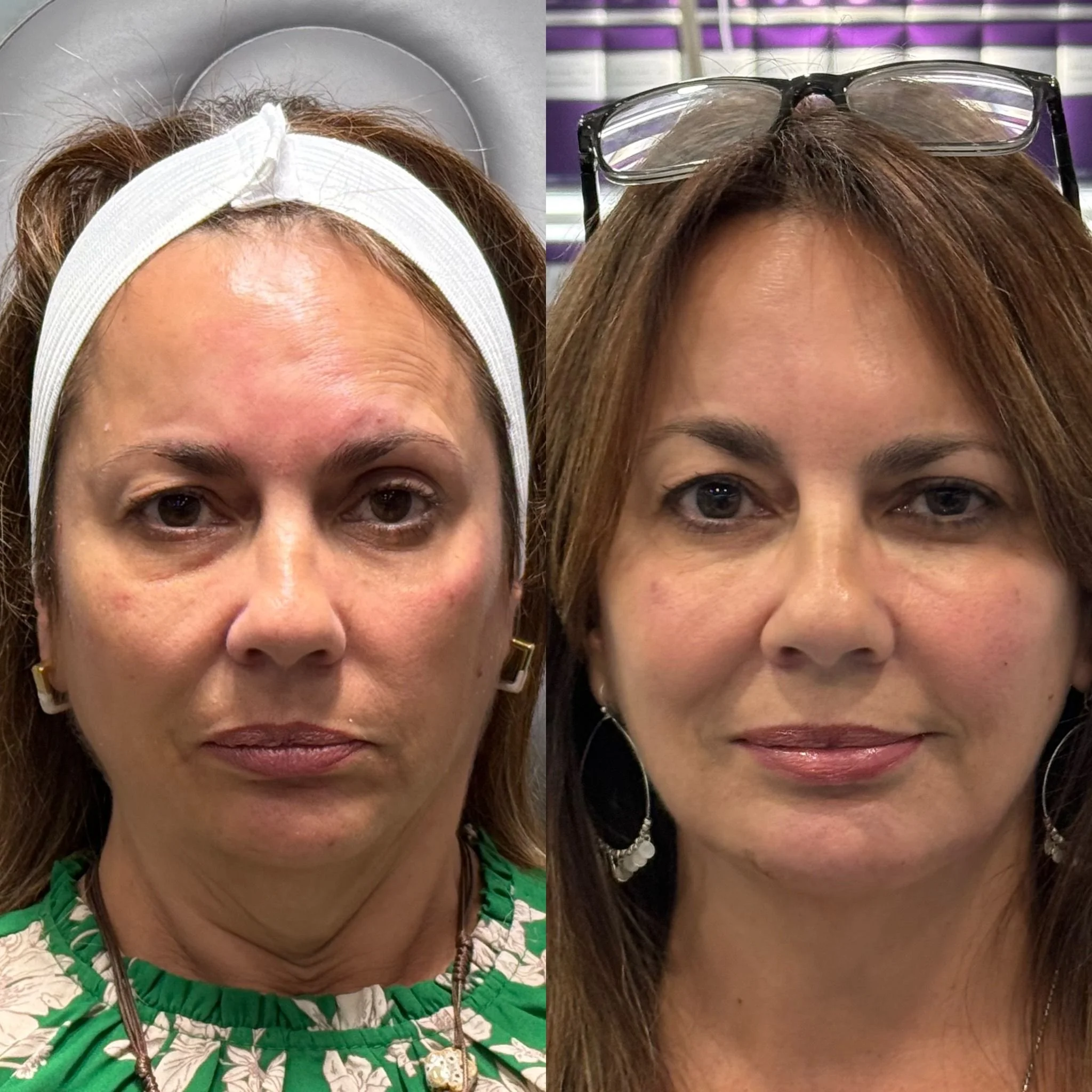 Entrecejo relajado y contorno facial más firme.
