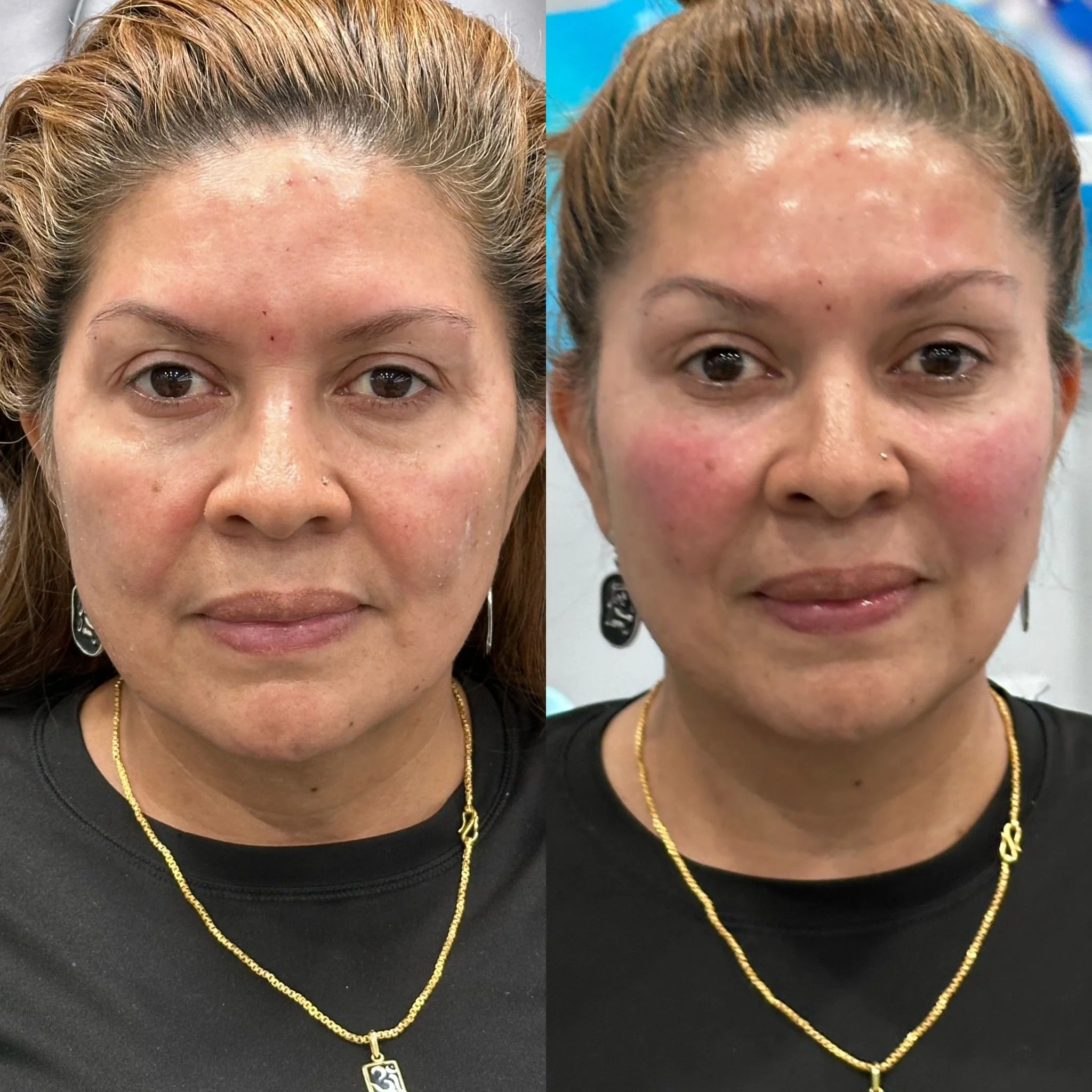 Pómulos con volumen restaurado y labios mejor definidos.