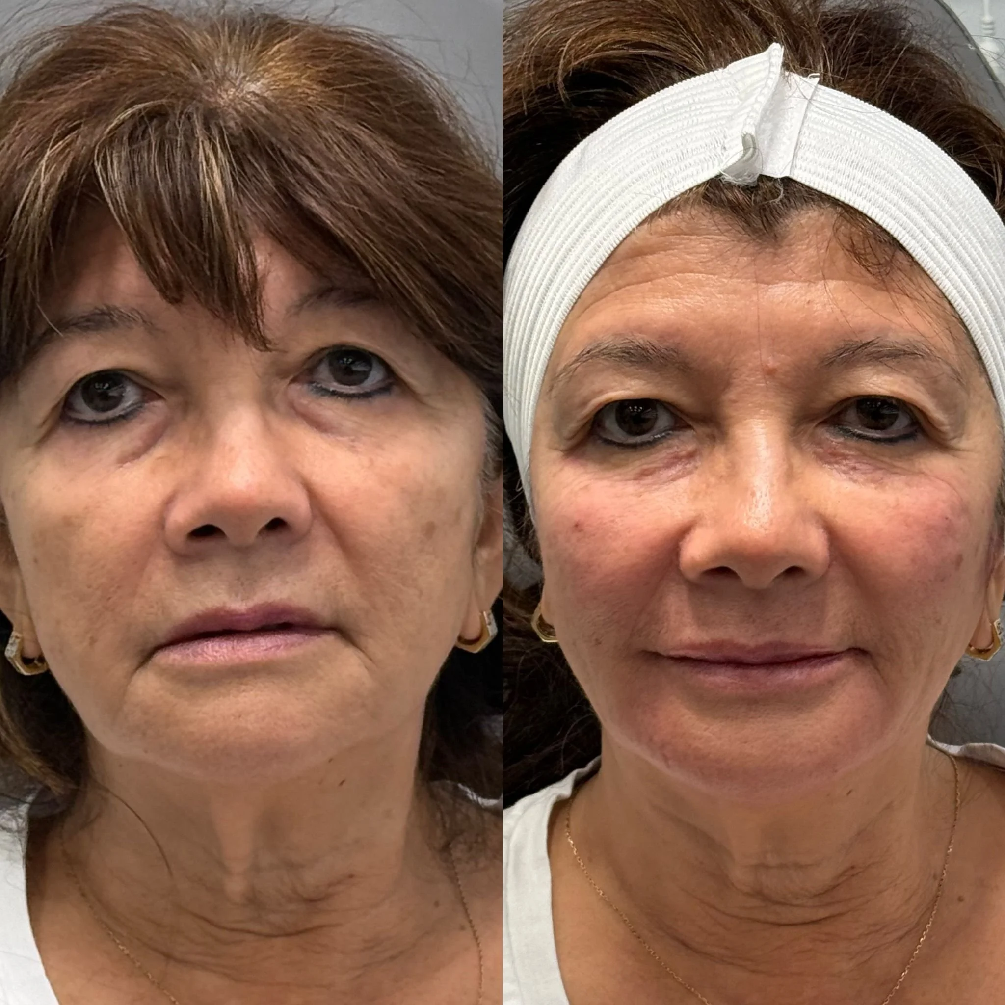 Ojeras y bolsas suavizadas, mirada más abierta y luminosa.