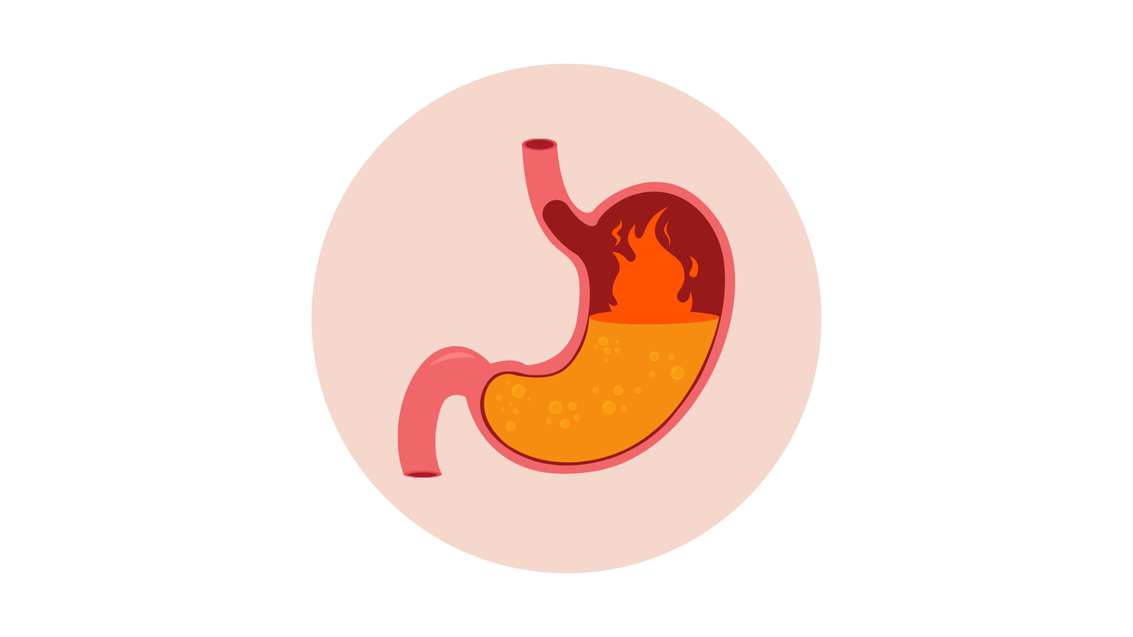 Heartburn, reflux or ulcers
