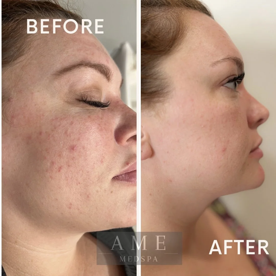 acne treatment leander texas