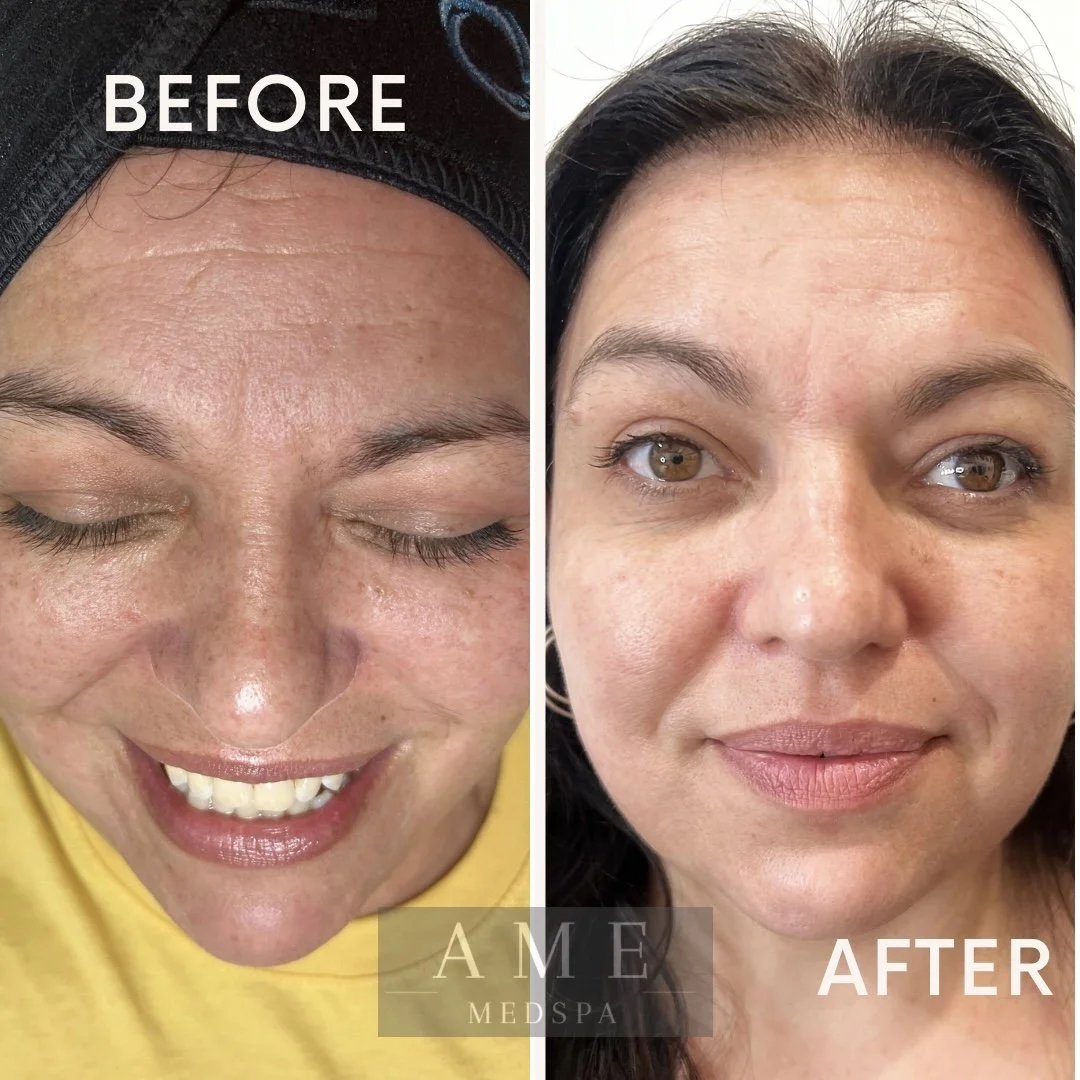 Side-by-side comparison of a woman's face before and after skincare treatment, showing improved skin texture and appearance.