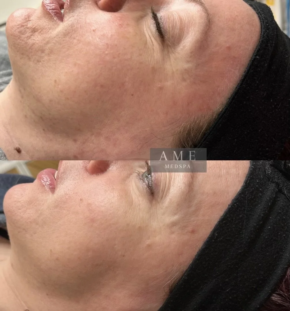 acne scar treatment leander texas