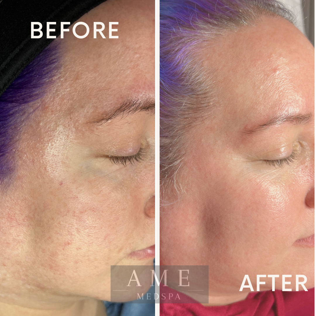 chemical peels Leander texas