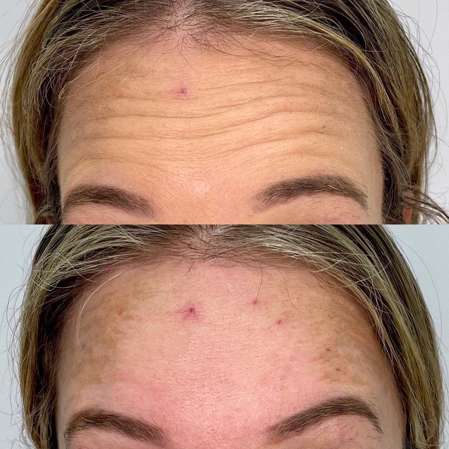 One of our beautiful clients looking smooth and refreshed after her anti-wrinkle treatment to the forehead area 💗💉

The client is raising her eyebrows in both photos.