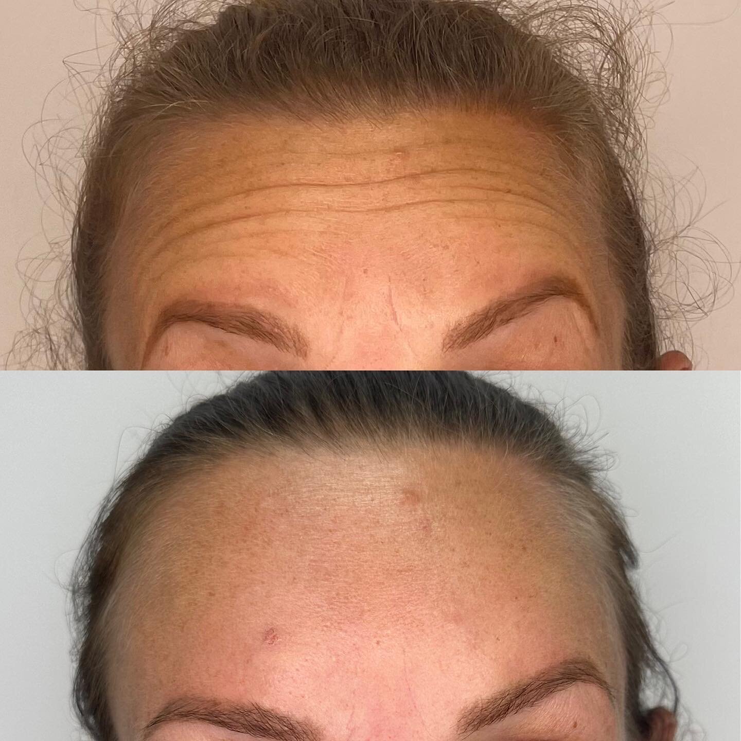 Forehead &amp; frown refresh for this beautiful client 💗🪄*in the 1st photos the client is raising her eyebrows and in the 2nd photos she is frowning. 

#botoxauckland #botoxbeforeandafter #naturallookbotox