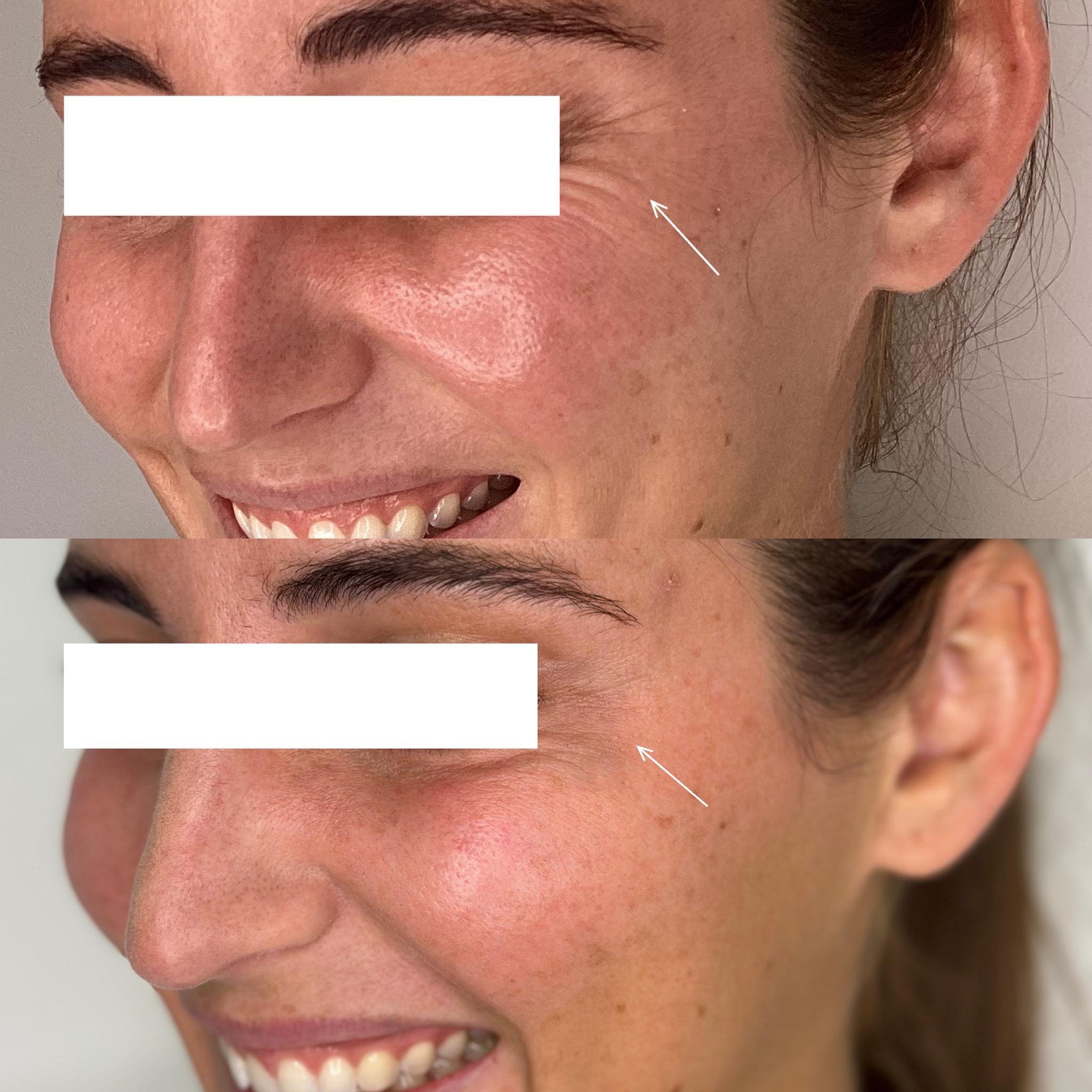 Anti-wrinkle treatment for crow&rsquo;s feet lines around the eyes for one of our stunning clients last week. Natural looking results are the best kind of results! 🪄🫶

*Individual results may vary.

Botox&reg;, Prescription Medicine. For the treatm