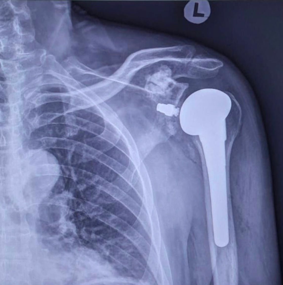 Dr Bryan Wang's total shoulder replacement