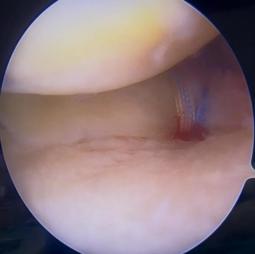 Dr Bryan's meniscus root repair 2
