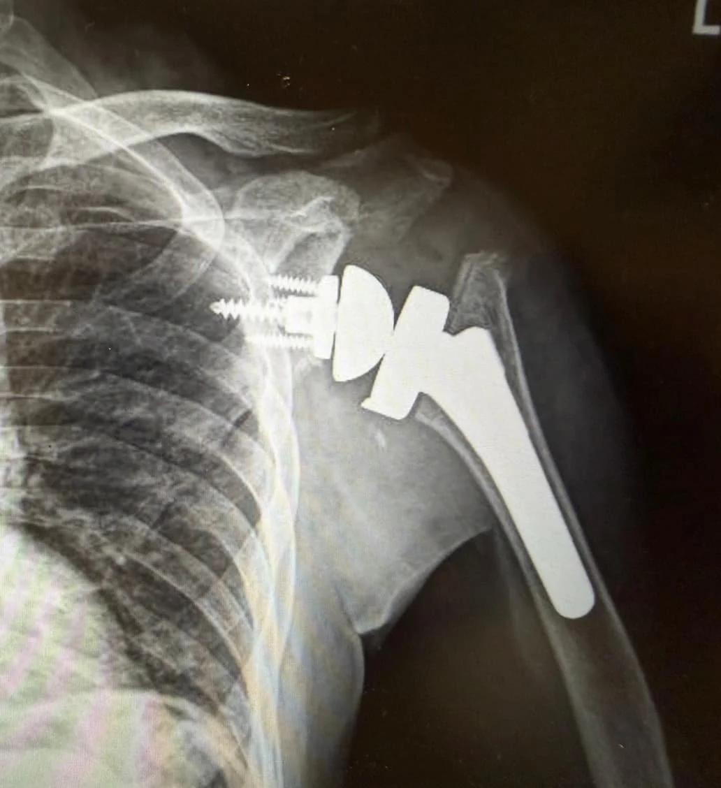 Dr Bryan Wang's reverse shoulder replacement