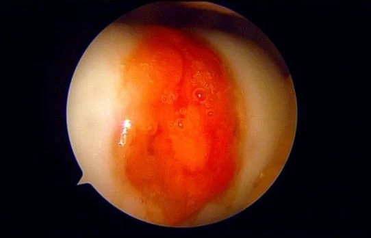 knee cartilage repair scope image
