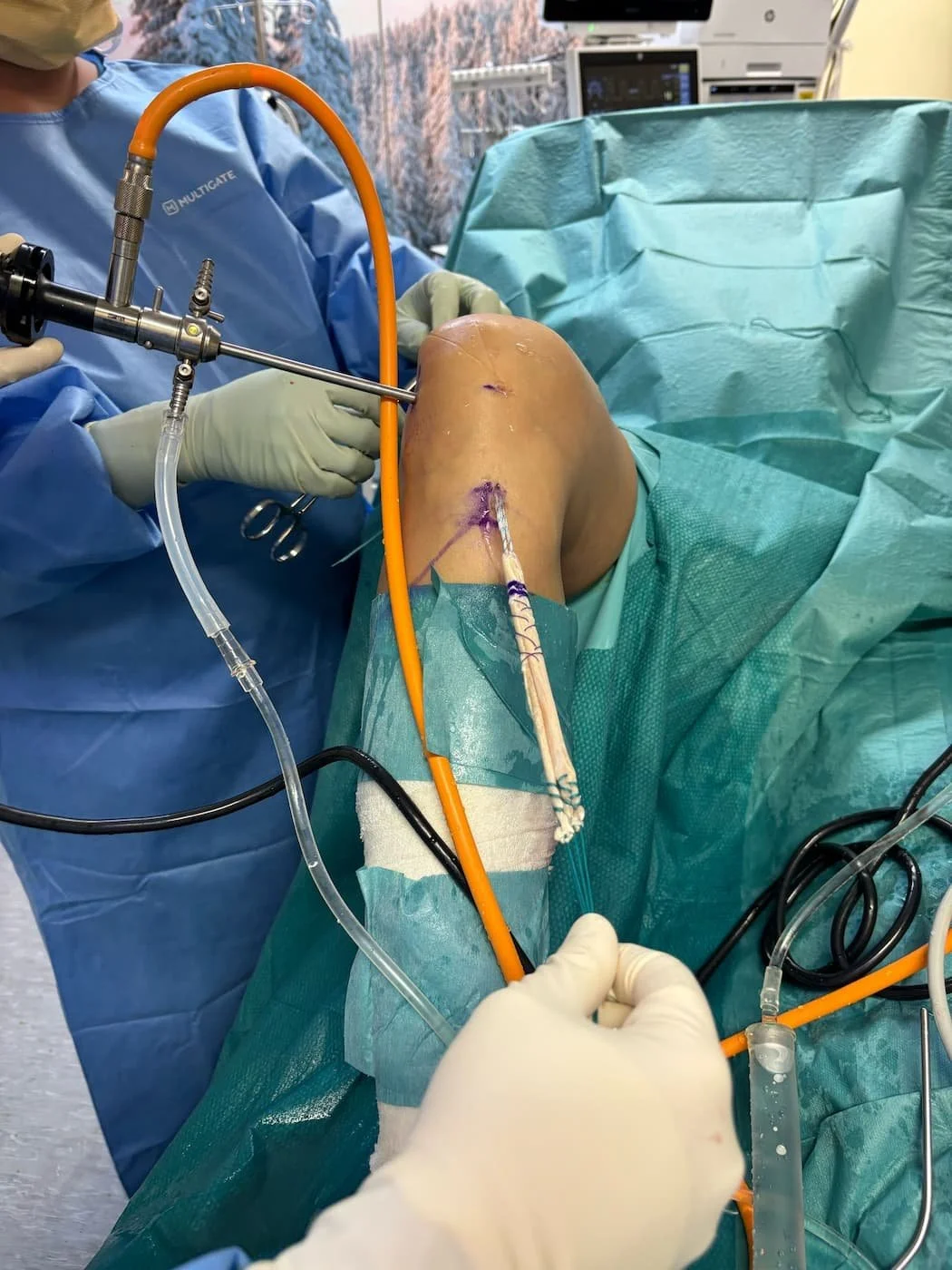 Dr Bryan Wang performing ACL recon keyhole surgery