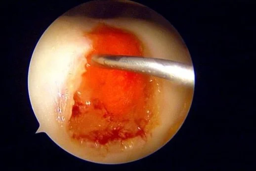 knee cartilage repair scope image