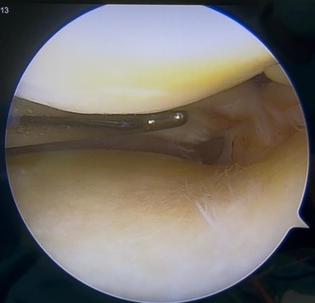 Dr Bryan's meniscus root repair 1