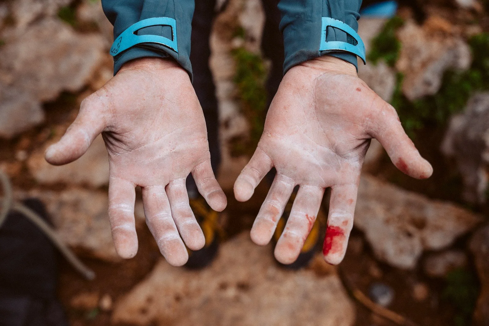Verletzte Hände mit Blut und Schrammen, vermutlich nach einem Unfall oder einer Klettertour.