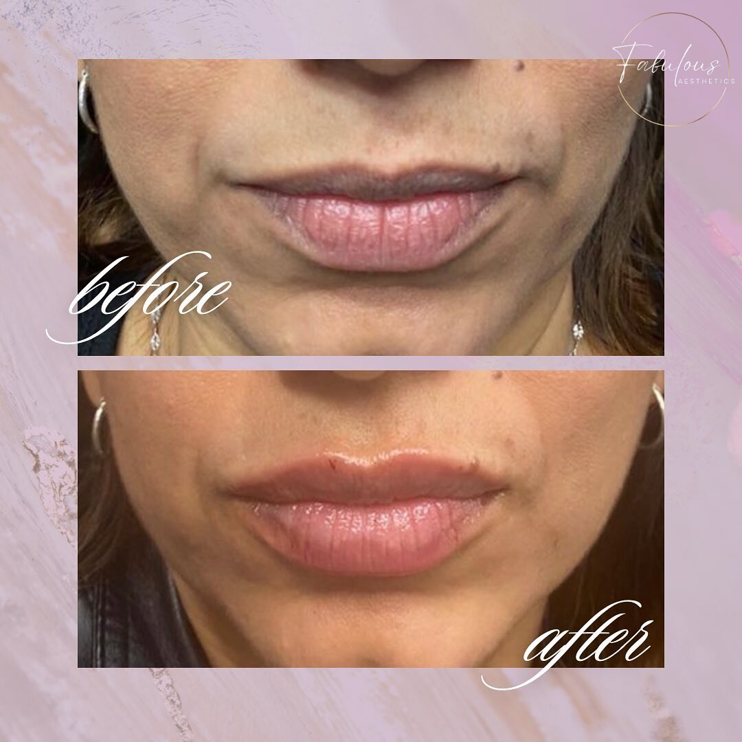 LIP FILLER 💋💉 Recieve $50 off your syringe ✨ New Clients only!

Book your treatment with me today! Visit the link in my bio 🔗 or TEXT to book 

Hablo espa&ntilde;ol! 👋

👩🏽&zwj;⚕️ Myriam Elizondo, RN, BSN
☎️ (956) 778-5734
💌 queenbinjector@gmai