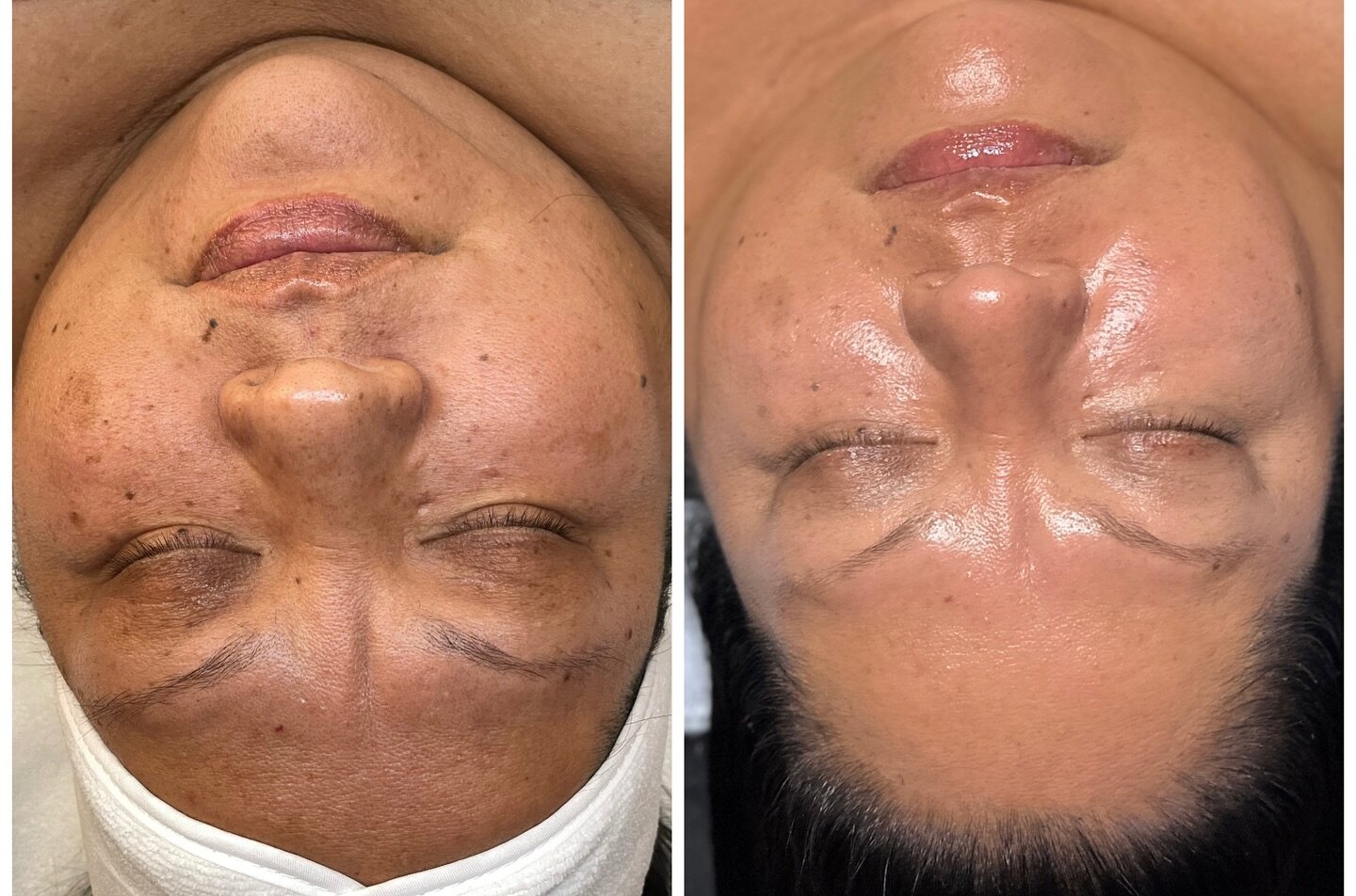 Monthly facials + clinical regimen = happy healthy skin 🩷💙

Going on 3 years with this beautiful lady🥹

&mdash;&mdash;&mdash;

You can purchase my online skin care consultation through the link in my bio and get a specialized treatment + skin care