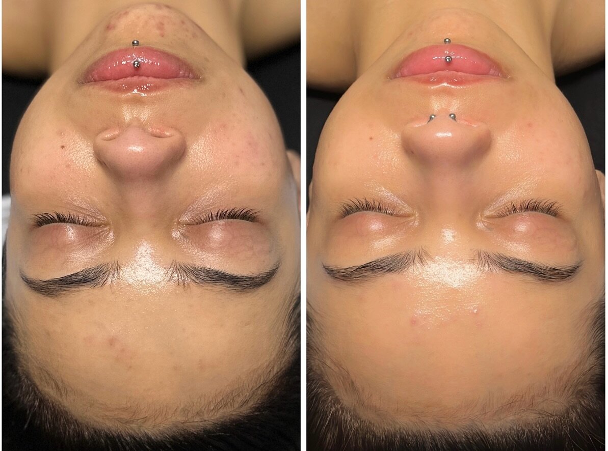 1 custom facial &amp; 2 weeks on her custom routine later🥺❣️

We can&rsquo;t believe this is a months difference already. It only gets better and better from here🥺

&mdash;&mdash;&mdash;

If you&rsquo;re ready to get your dream skin, LSB offers onl