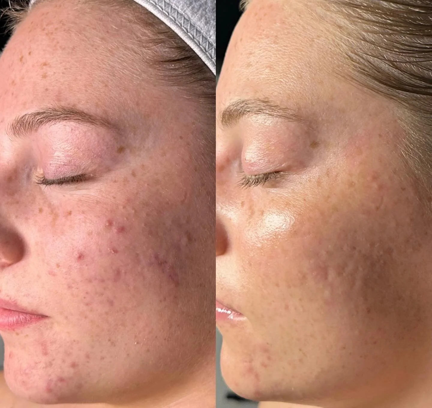 Healthy skin is the result of patience, care, and consistency 🤍

#luxeskinbar #skinbykristie #arizona #gilbert #Skintransformation #Healthyskin #Skinrevision #Skinhealing #Skincare