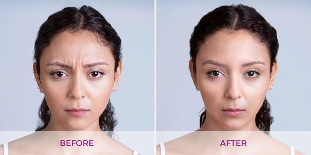 3-Xeomin-before-and-after-forehead-1024x510.jpg