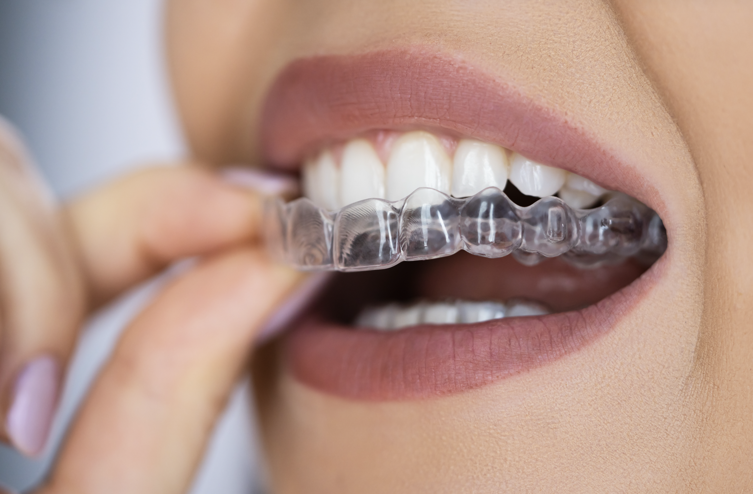 Clear Aligners: How SureSmile Compares to Braces