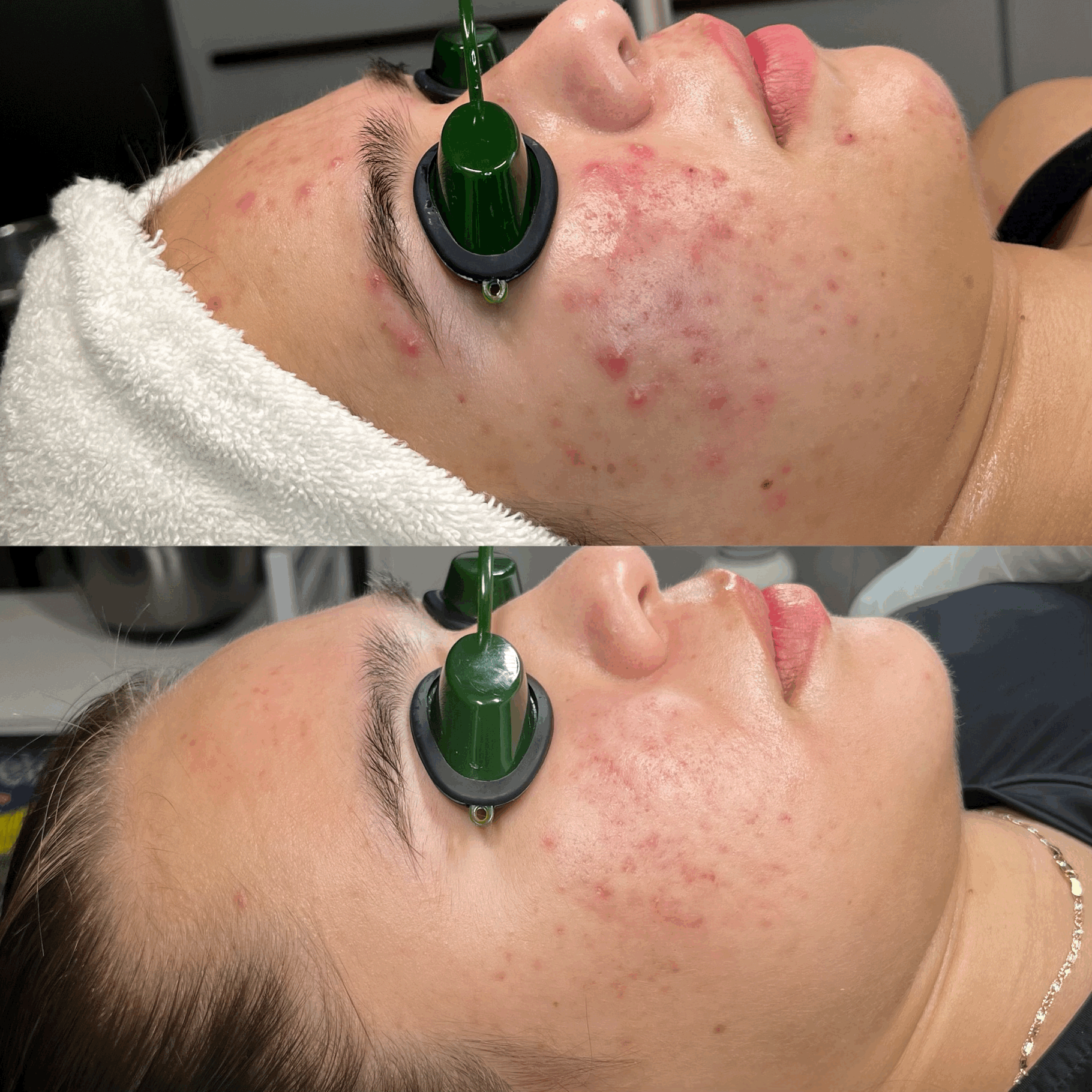Acne Bootcamp Before & After