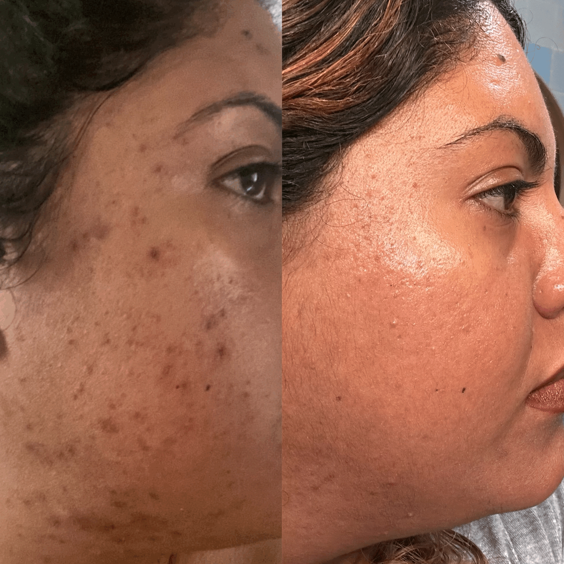 Acne Bootcamp Before & After