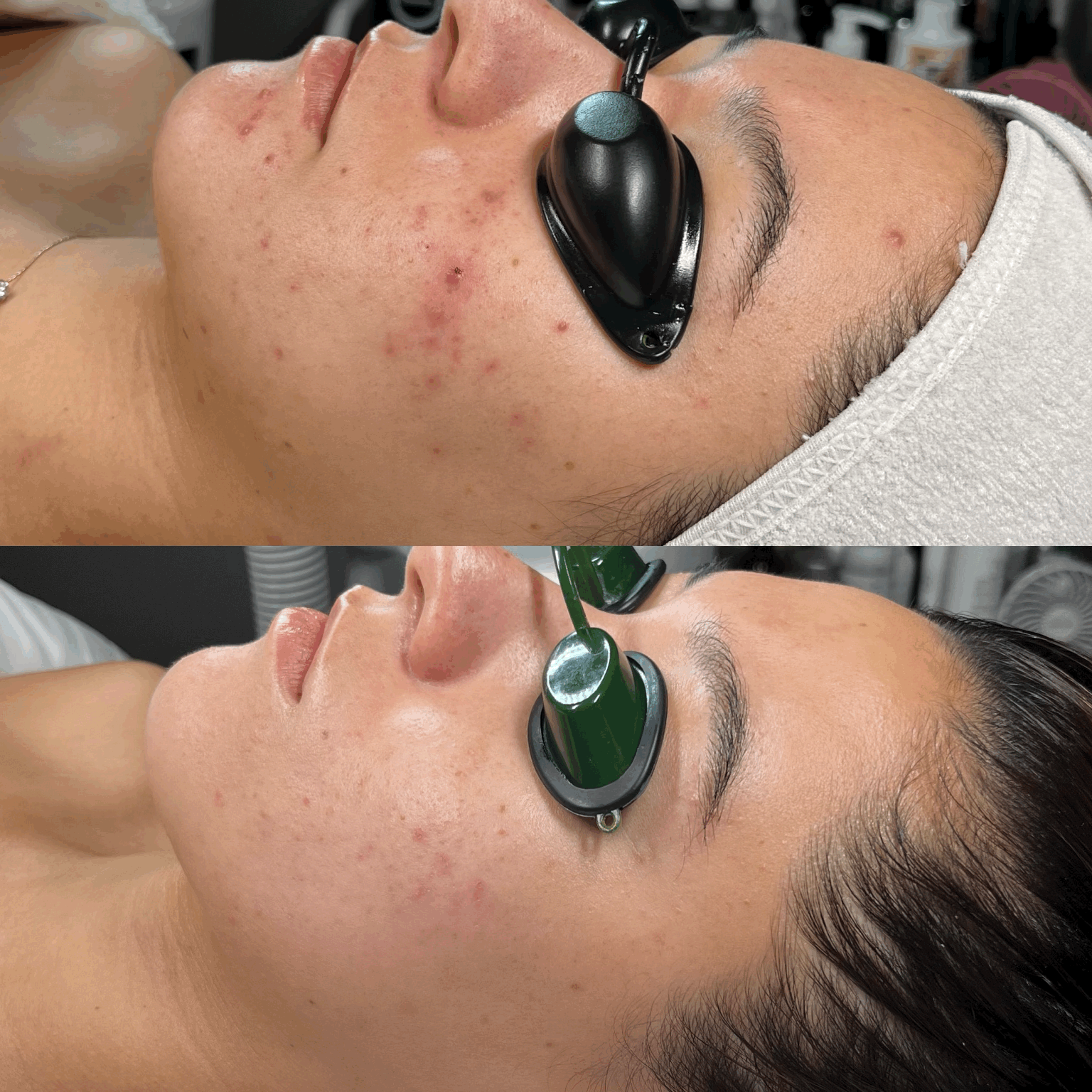 Collegen Induction Therapy Before & After