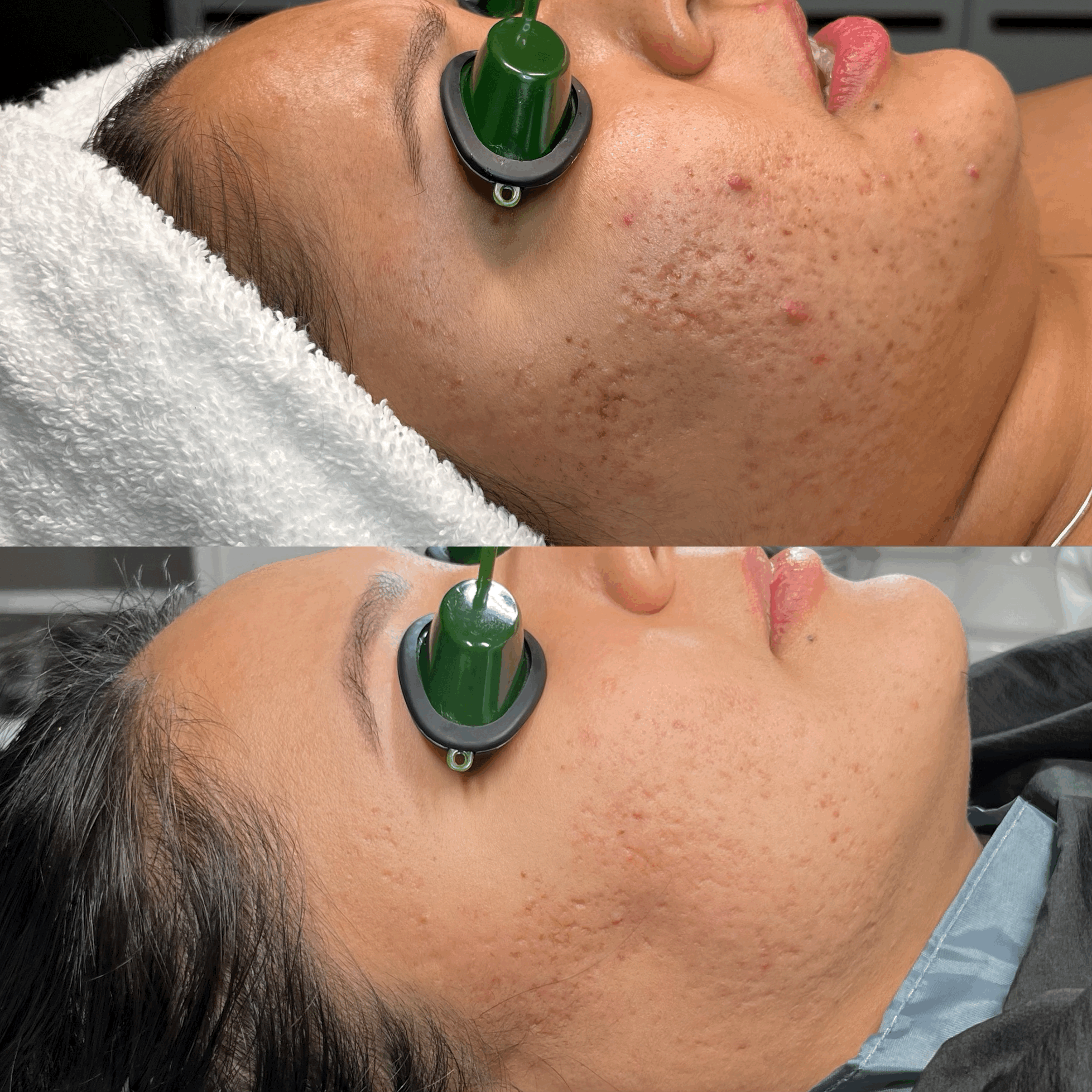 Collegen Induction Therapy Before & After