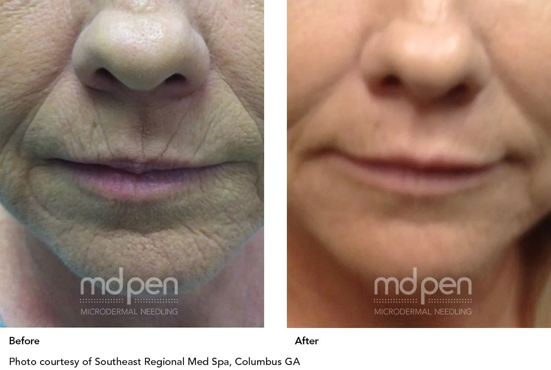 MDPen_BeforeAfter_011419_CM after half.jpg