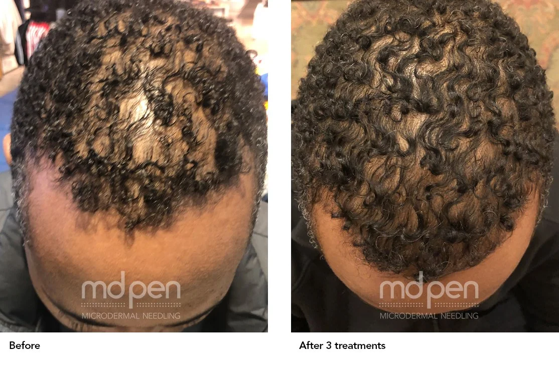 MDPen_BeforeAfter_022620_hair.jpg