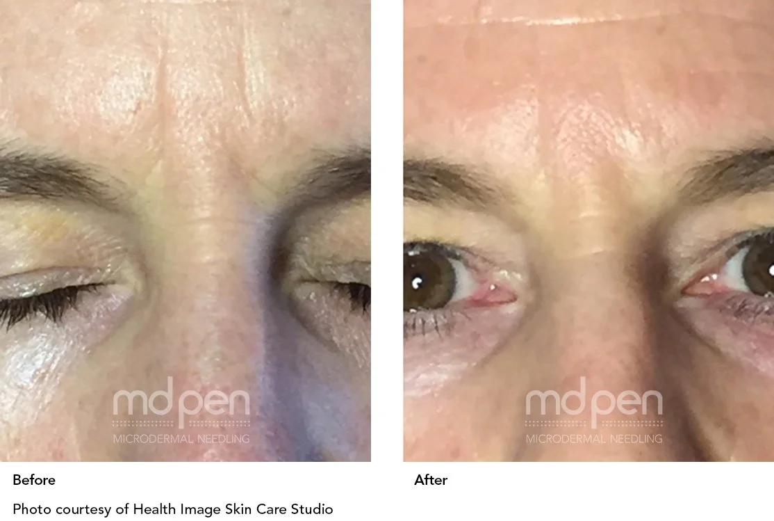 MDPen_BeforeAfter_011419_forehead_v_03.jpg