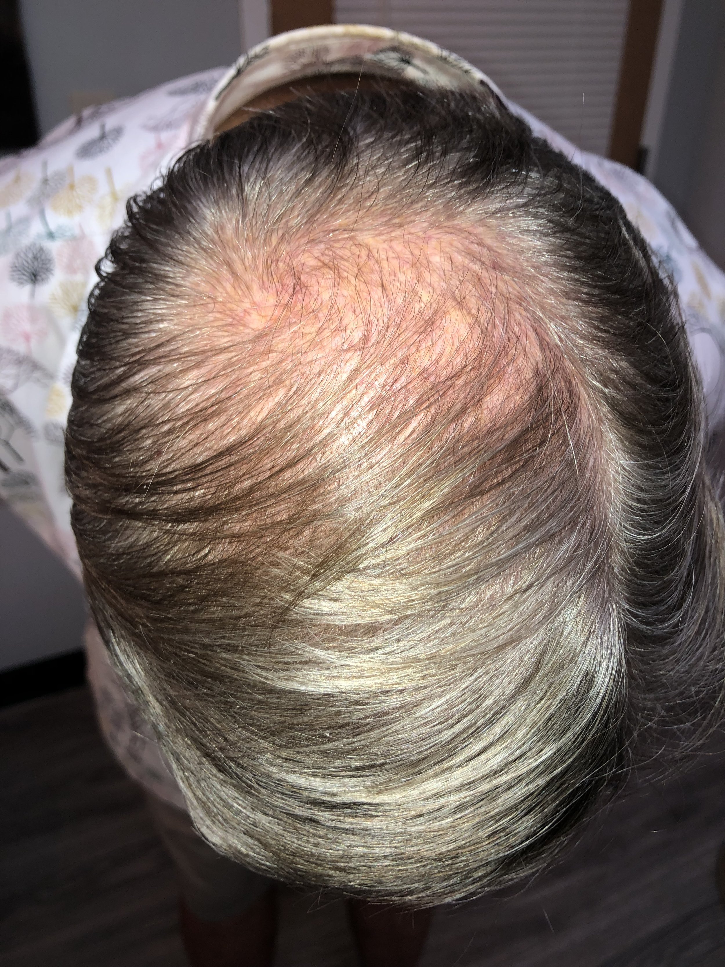 Male balding 70 y.o.