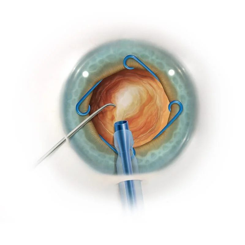 MST Malyugin Ring.jpeg