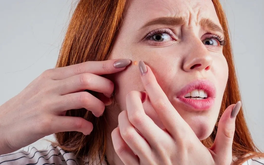 Clear Skin Tips: How to Get Rid of Pimples Fast