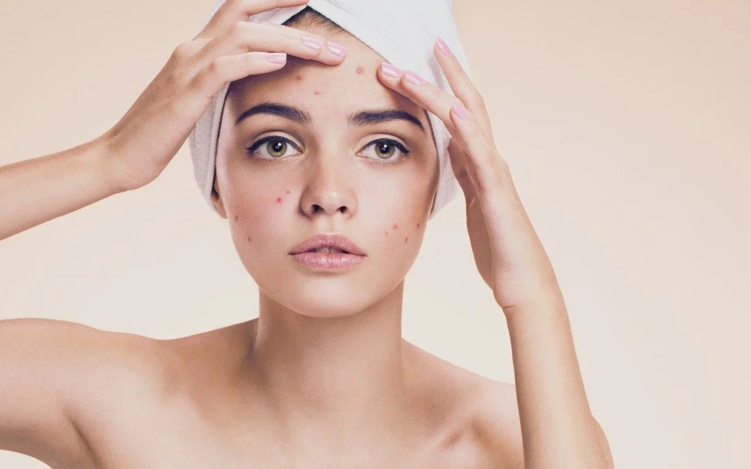 How to Treat A Popped Pimple