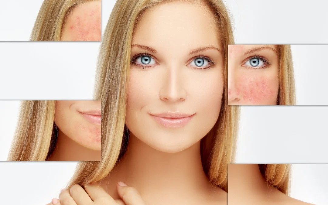 The Truth About Rosacea: Causes and Treatments