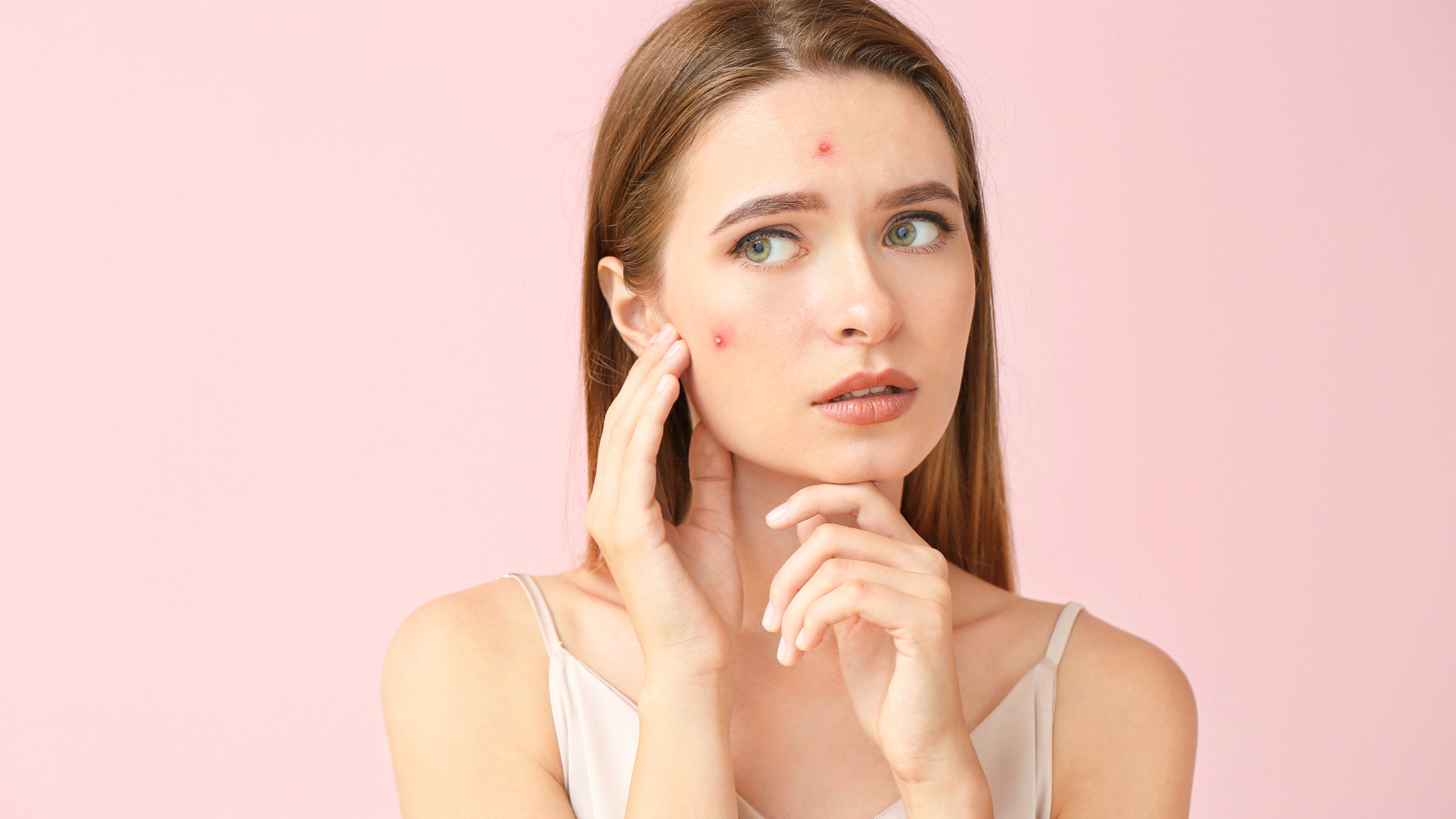 How to Deal with Adult Acne