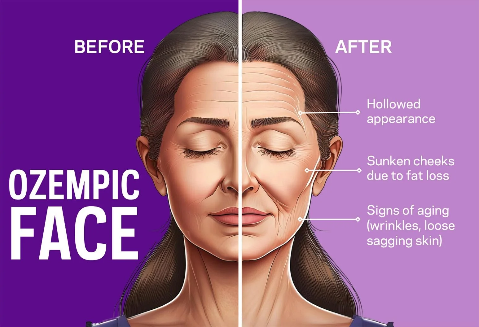 Ozempic Face &amp; Rapid Weight Loss: How to Restore Volume and Tighten Skin Without Surgery