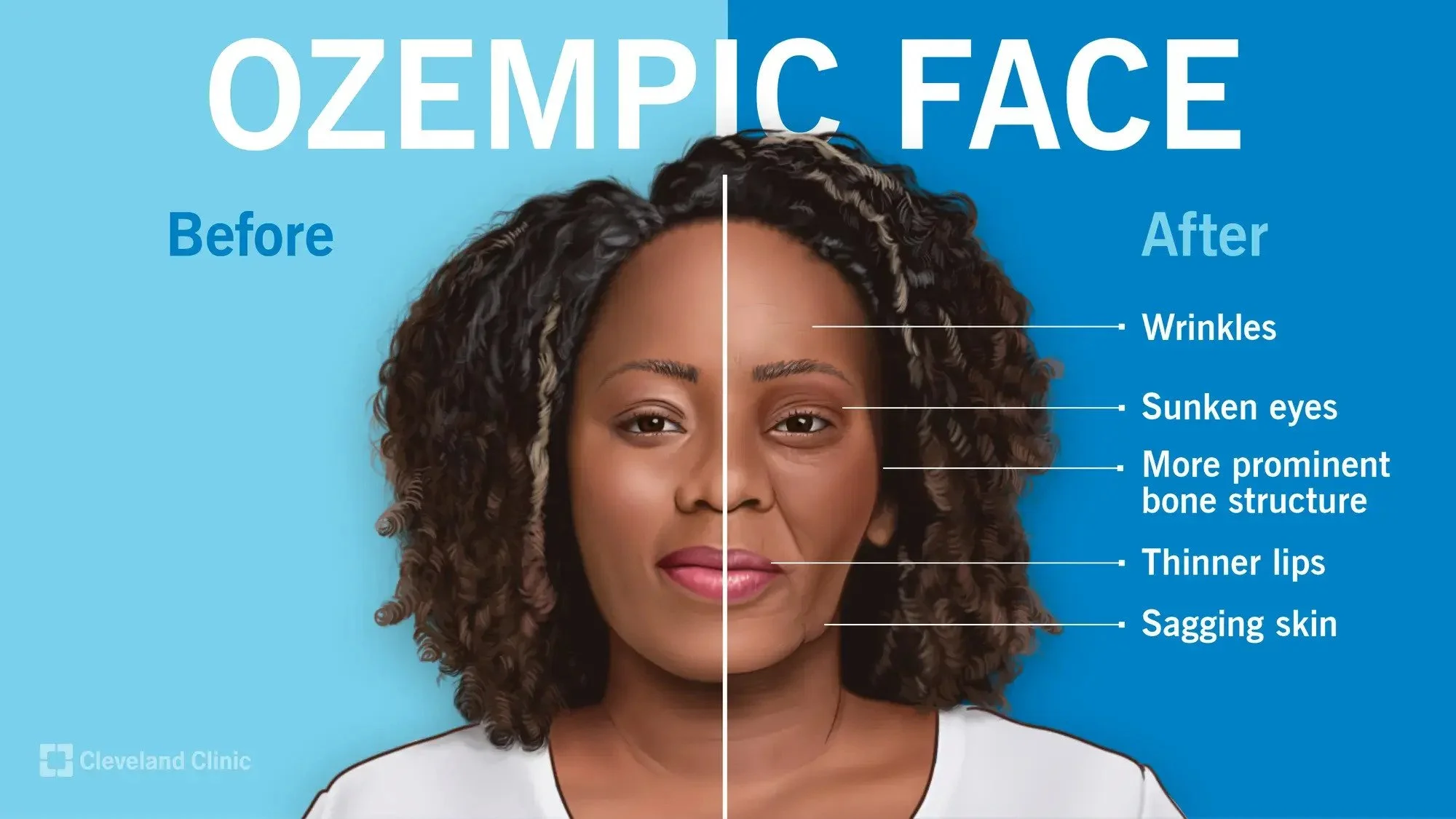 What Is Ozempic Face? Understanding Facial Volume Loss &amp; Treatment Options