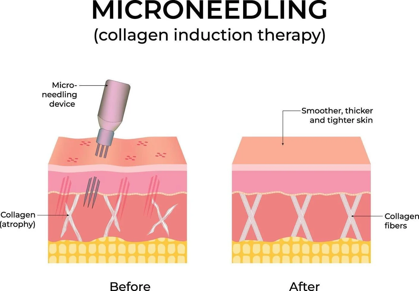 Which Collagen-Stimulating Treatment Is Right for You?