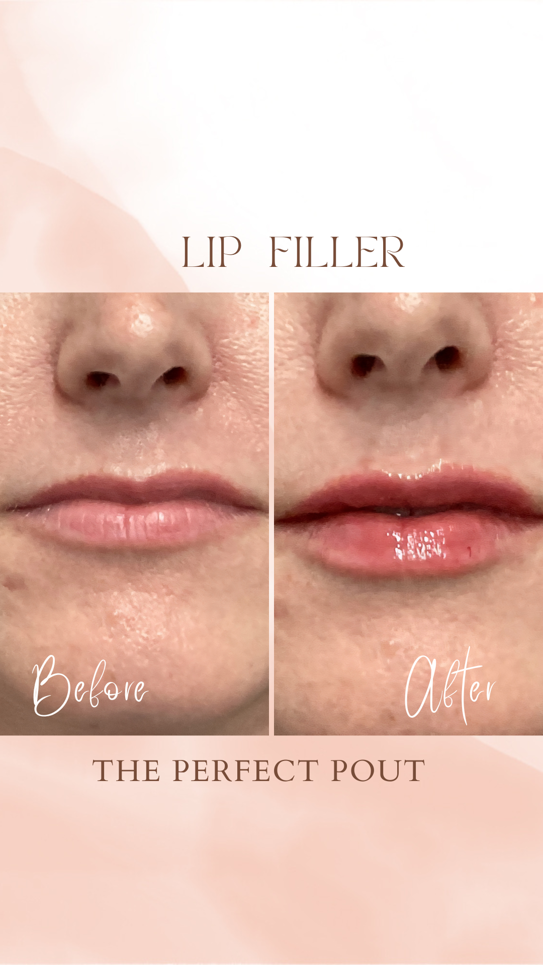 How Much Lip Filler Do I Actually Need? ½ Syringe vs. Full Syringe Explained