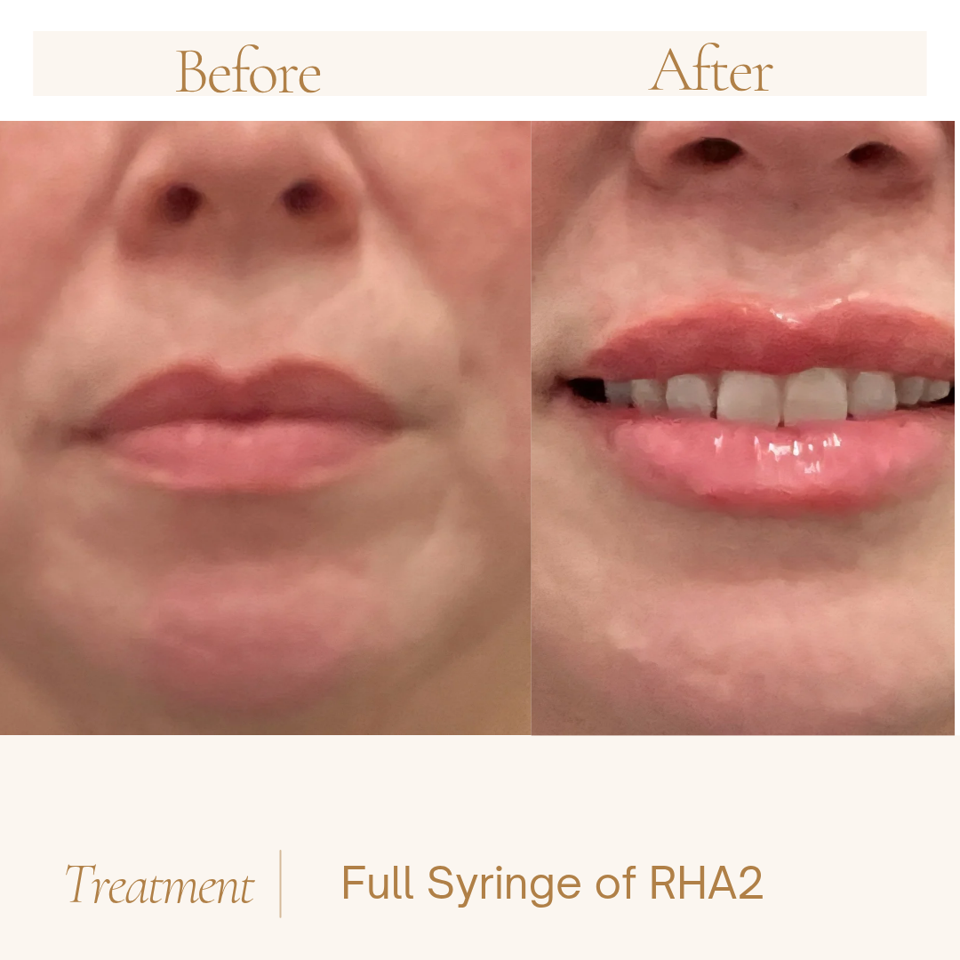 What Makes Lip Filler Look Natural? It's Not Just About Using Less