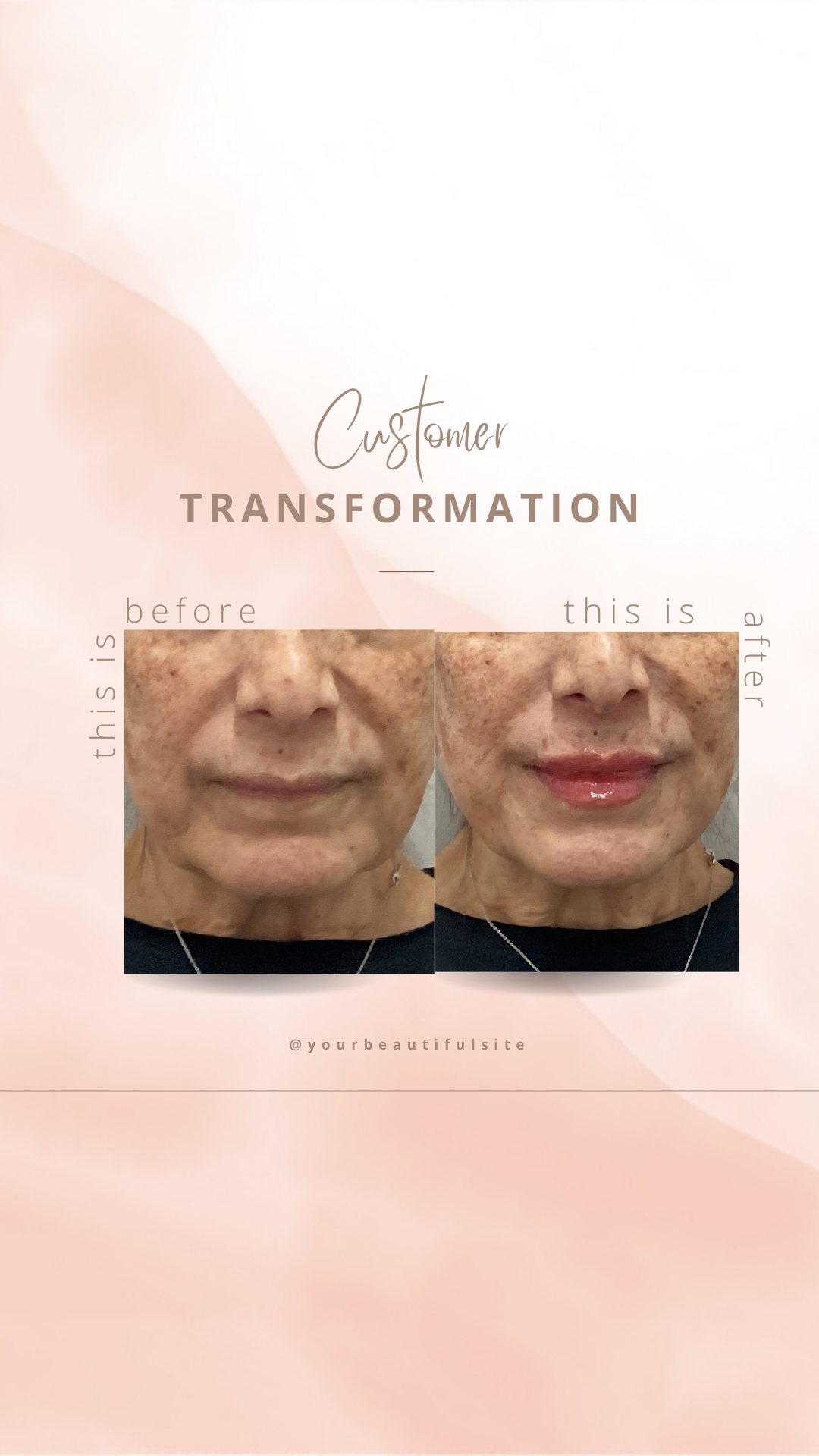 What Is Facial Balancing—and Does It Always Mean Getting More Filler?