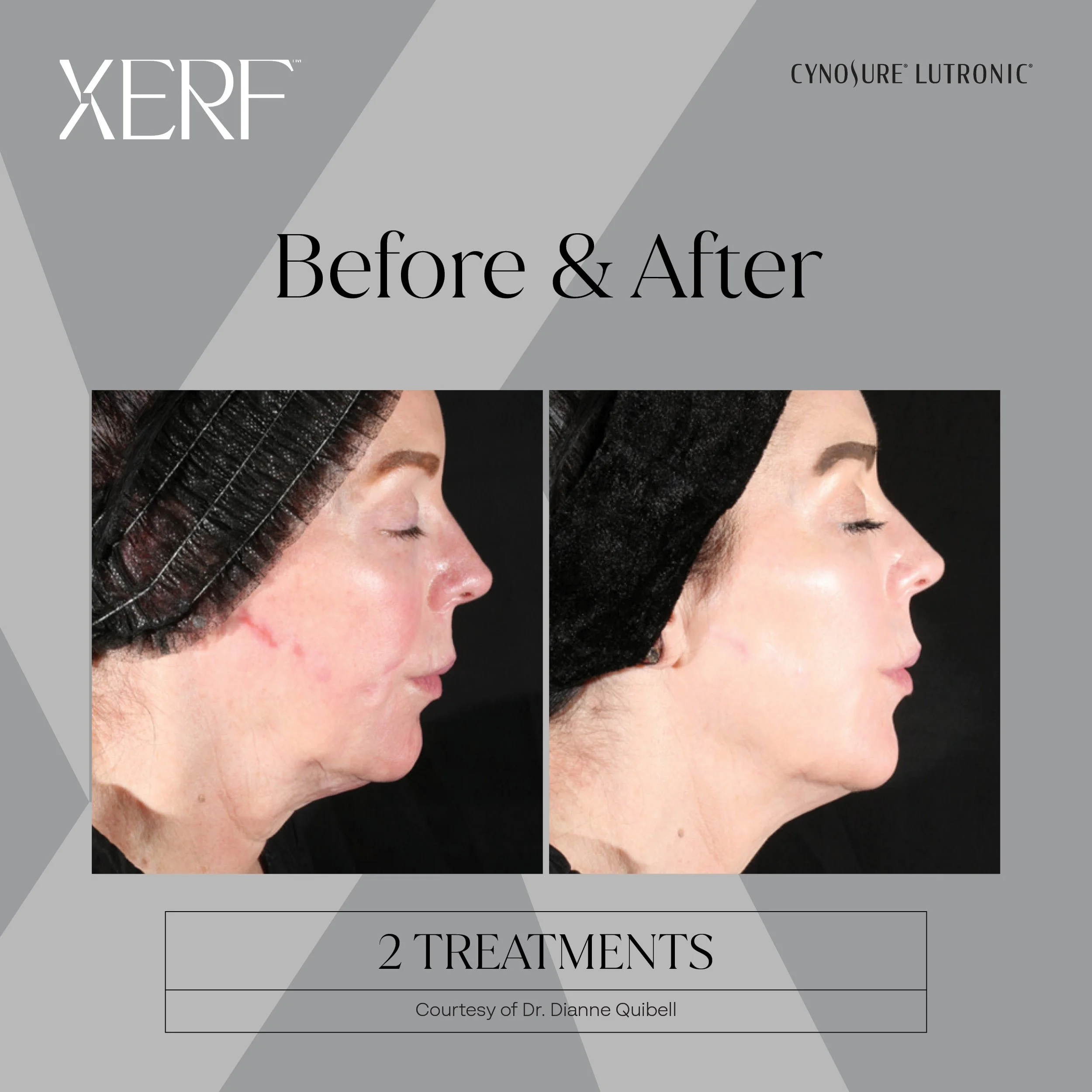 Side-by-side comparison of a woman's face before and after two skin treatments showing improved skin texture and reduced wrinkles.