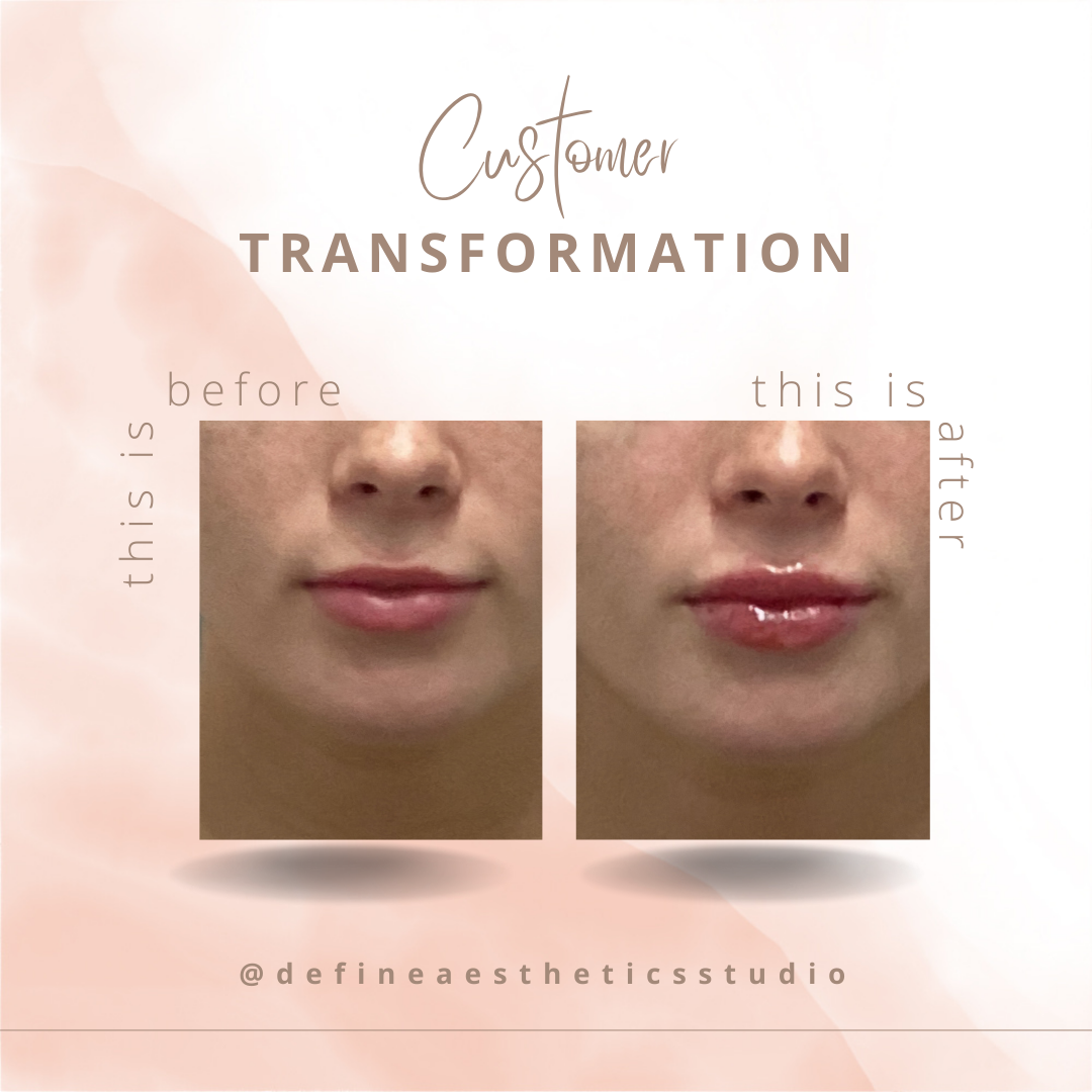 Side-by-side comparison of a woman's lips before and after cosmetic lip gloss application, showing fuller, shiny lips after.