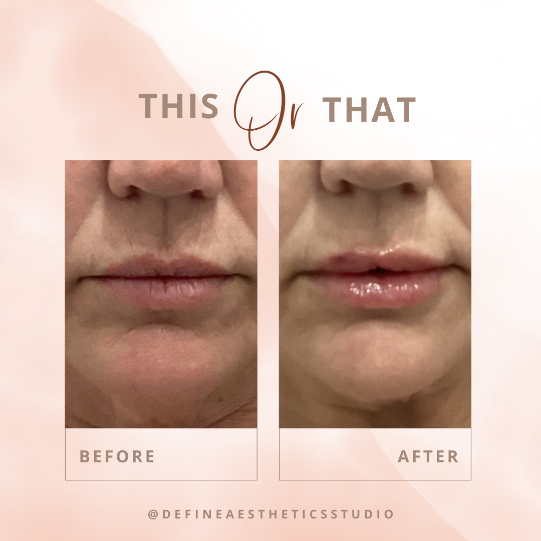 Side-by-side comparison of a woman's lips and mouth before and after a cosmetic procedure, with the words 'This or That' at the top and 'Before' and 'After' labels.