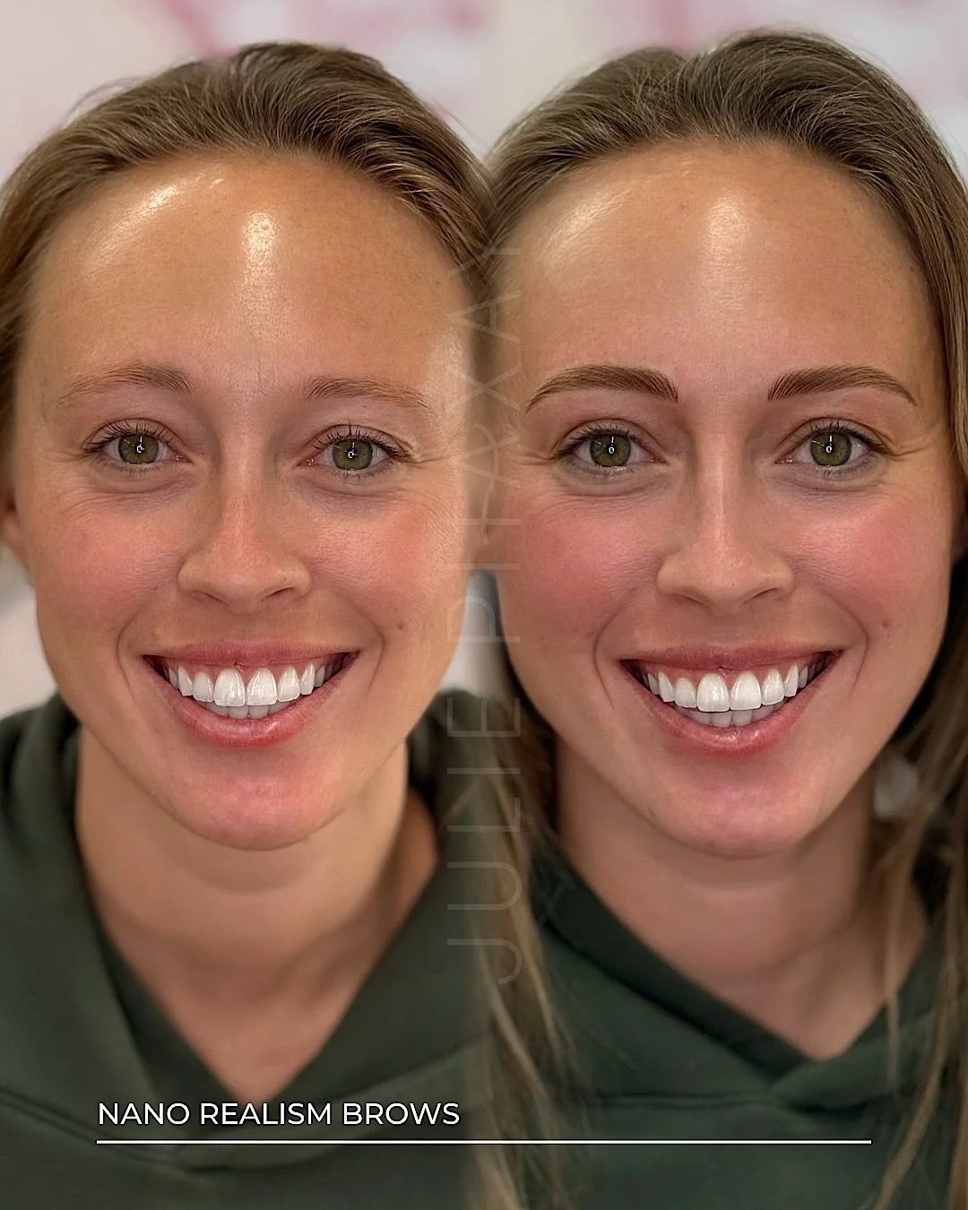 You shouldn&rsquo;t have to draw your face on every single morning.

She flew in from Denver because she was done, done with sparse brows, done with filling them in, done settling. She also had some natural asymmetry we were able to improve, which ma