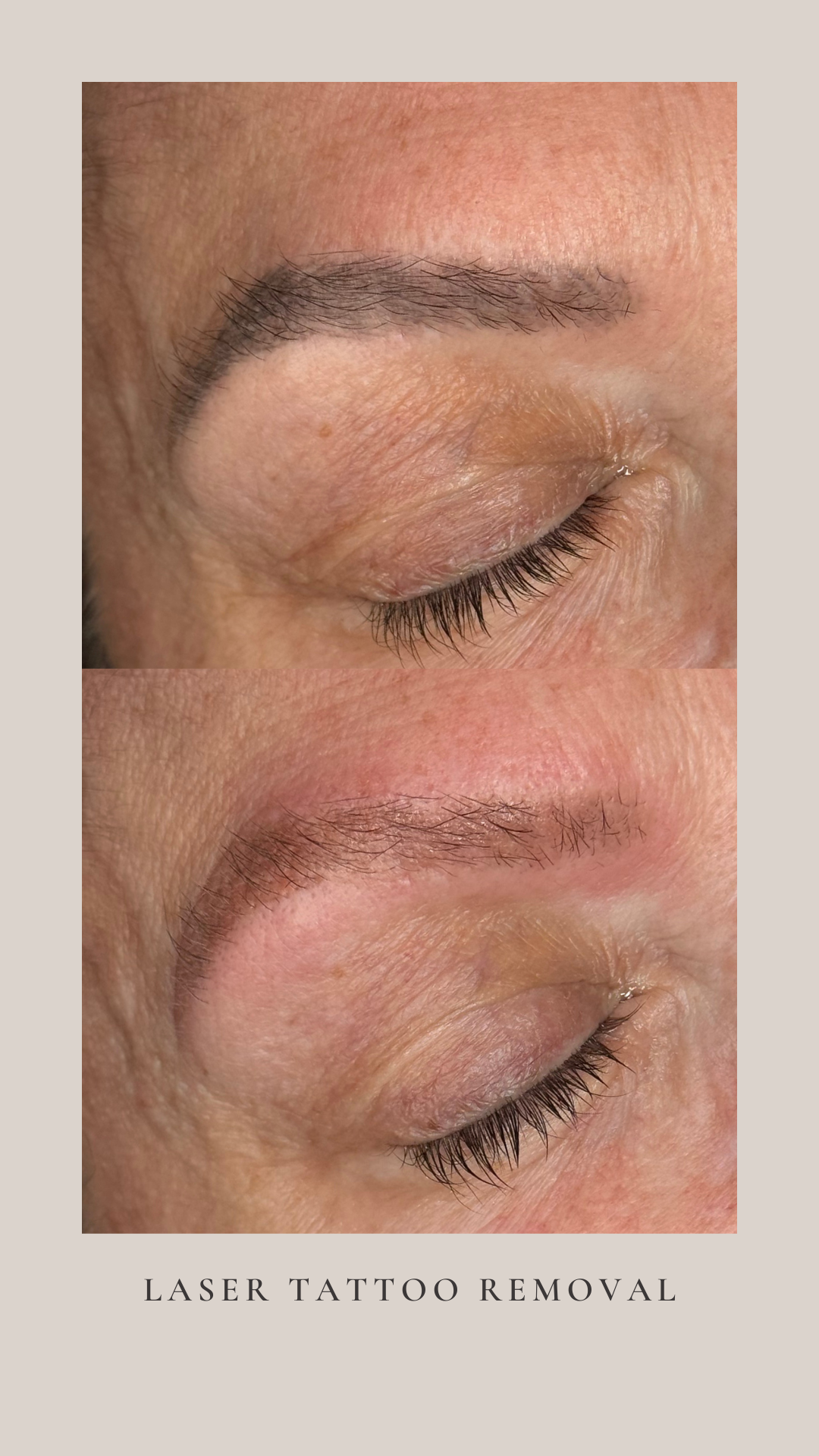 Laser Tattoo Removal done by Julie Phaxay in Minneapolis, Minnesota